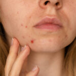Can Laser Acne Scar Treatment Help Deep Scars