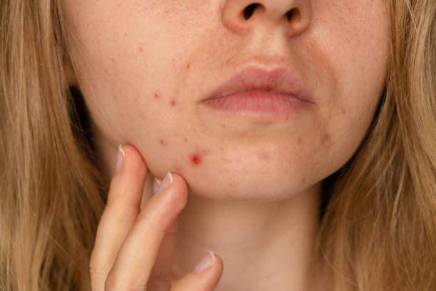 Can Laser Acne Scar Treatment Help Deep Scars