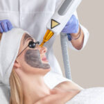 Can Laser Carbon Peeling Reduce Fine Lines