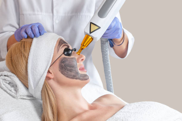 Can Laser Carbon Peeling Reduce Fine Lines