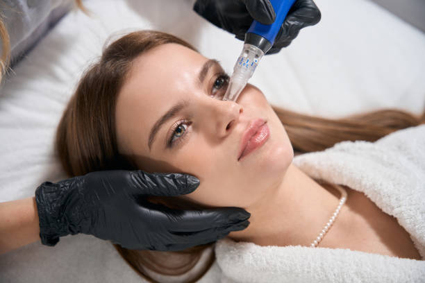 Can Microneedling Improve Uneven Skin Tone