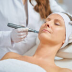 Can Microneedling for Acne Scars Reduce Fine Lines
