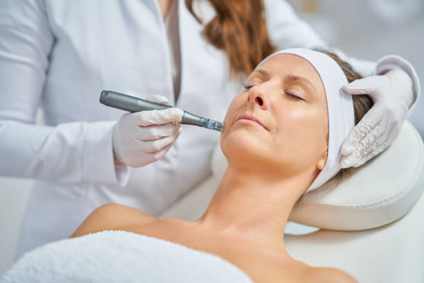 Can Microneedling for Acne Scars Reduce Fine Lines