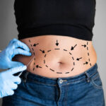 Can Mini Tummy Tuck Flatten Lower Abdomen