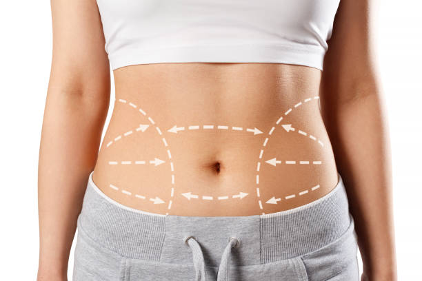 Can Mini Tummy Tuck Remove Stretch Marks