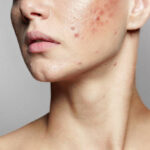 Does Acne Treatment Prevent Future Breakouts