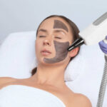 Does Laser Carbon Peeling Remove Blackheads