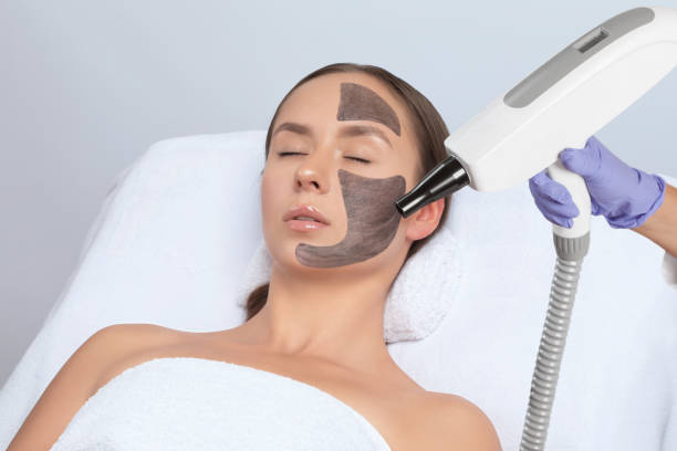 Does Laser Carbon Peeling Remove Blackheads