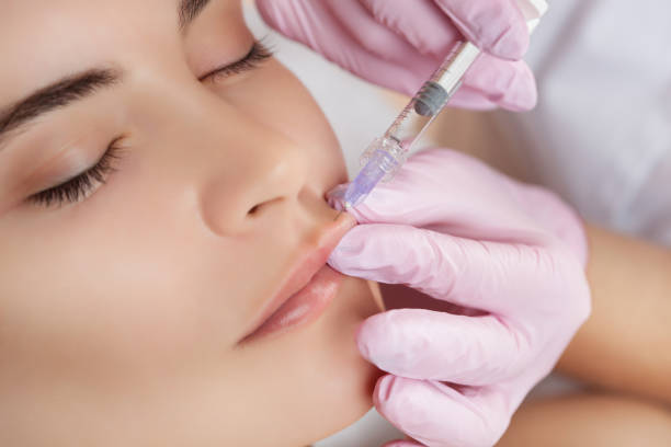 Does Lip Fillers Injection Look Natural Over Time