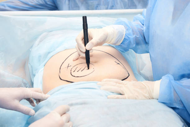 Liposuction Abu Dhabi