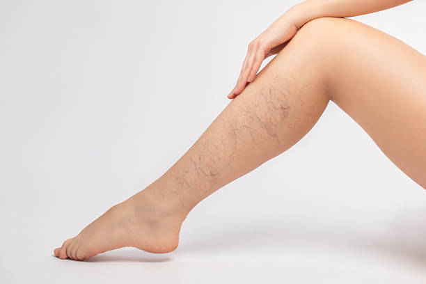 Does Spider Veins Treatment work on older veins