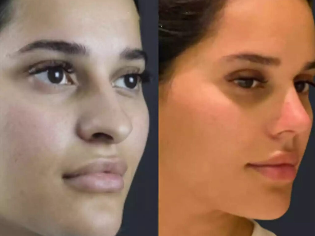 Rhinoplasty in Dubai