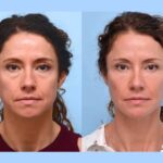 Thread lift Treatments in Dubai: Affordable Enhancement Packages Available
