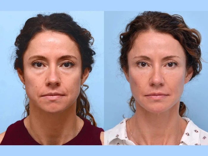 Thread lift Treatments in Dubai: Affordable Enhancement Packages Available