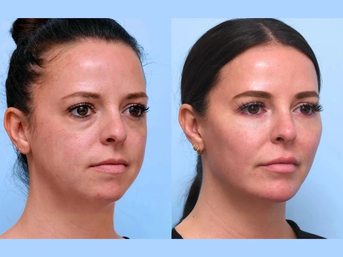 Thread Lift Treatments in Dubai: Safe Solutions for Facial Rejuvenation and Tightening