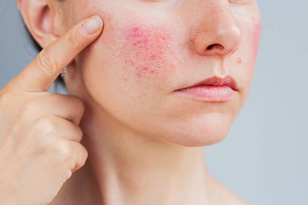 Is Acne Treatment effective for whiteheads
