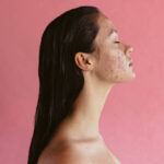 Is Laser Acne Scar Treatment Effective for All Skin Types