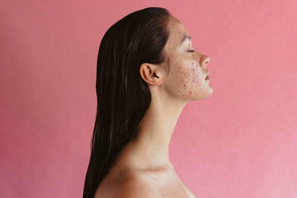 Is Laser Acne Scar Treatment Effective for All Skin Types