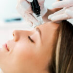 Is Microneedling for Acne Scars Good for Sensitive Skin
