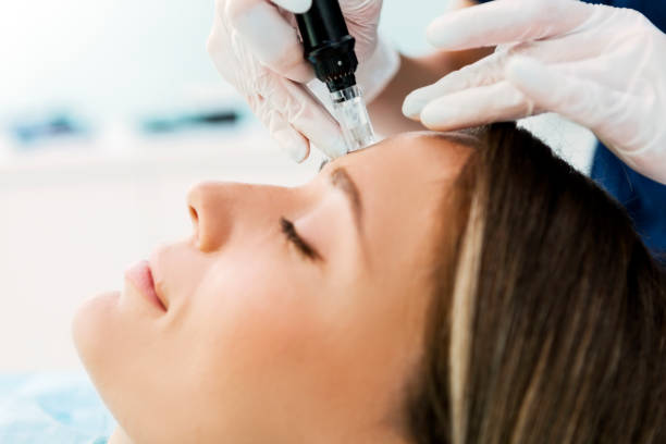 Is Microneedling for Acne Scars Good for Sensitive Skin