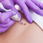 Is Mole Removal effective for body moles