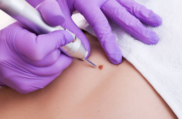 Is Mole Removal effective for body moles