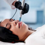 Is RF Microneedling Effective for Fine Lines