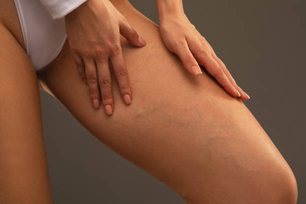 Is Spider Veins Treatment a Lasting Solution