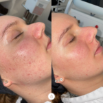 Menopause skin treatment clinic