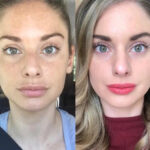 Radiofrequency (RF) Microneedling in Dubai