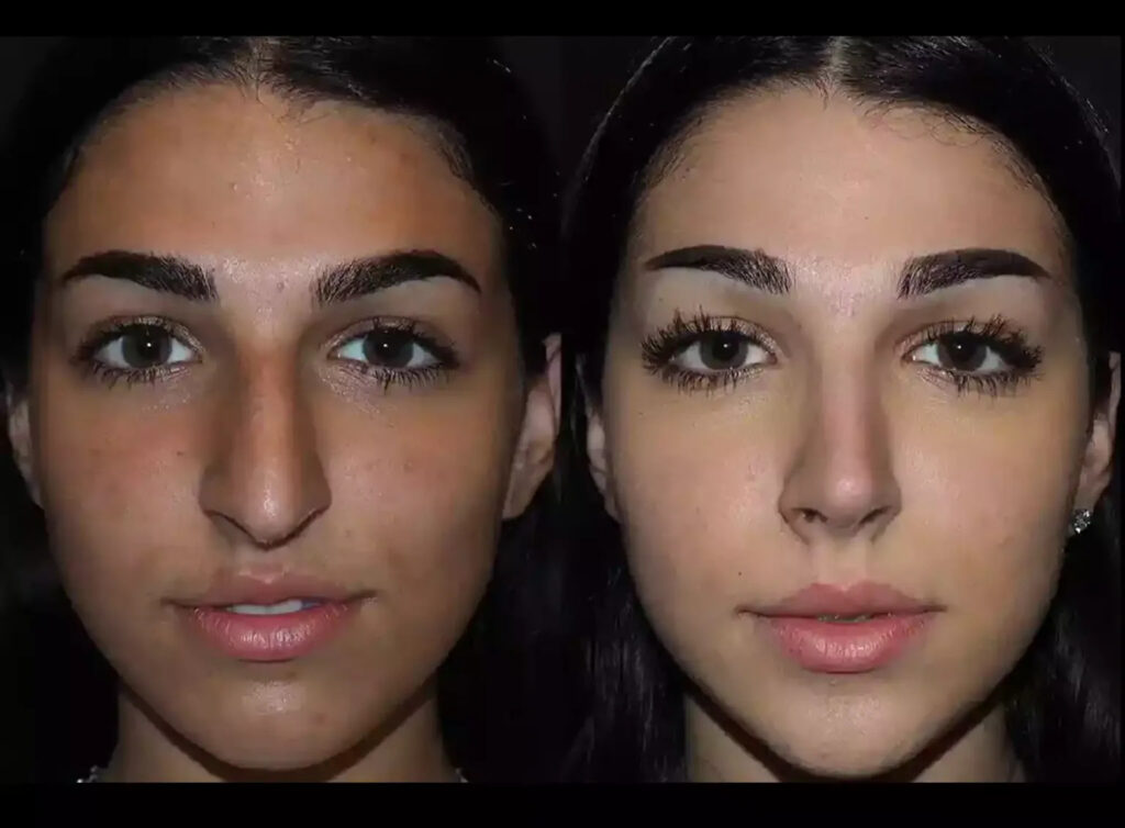 Septoplasty in Dubai