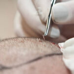 What Are the Benefits of Hair Transplant In Abu Dhabi