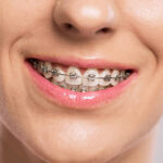 What Makes Dental Braces Worth Considering