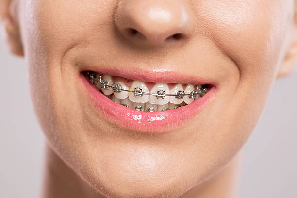 What Makes Dental Braces Worth Considering