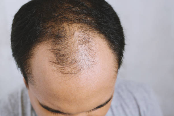 What Makes GFC Treatment for Hair Effective