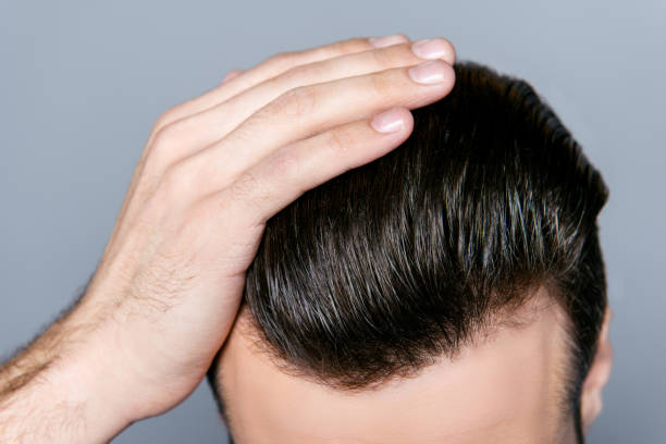 What Makes Hair Transplant Cost Increase