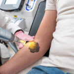 What Makes Laser Tattoo Removal More Effective