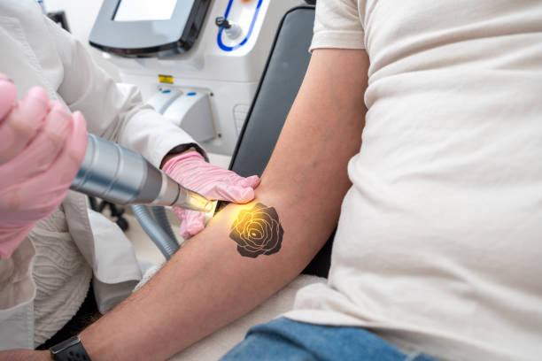 What Makes Laser Tattoo Removal More Effective