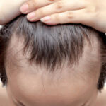 What Makes PRP Hair Treatment a Hair Growth Solution