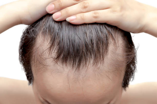 What Makes PRP Hair Treatment a Hair Growth Solution