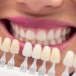 teeth whitening