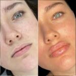 dermal fillers
