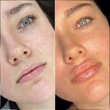 dermal fillers