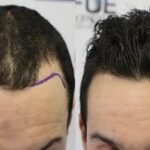 زراعة الشعر في الرياض