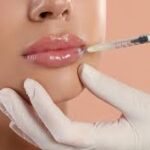Dezente Lippenvergrößerung