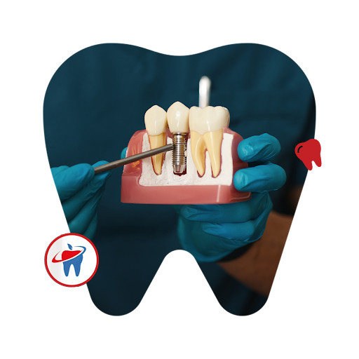 teeth implant Perth