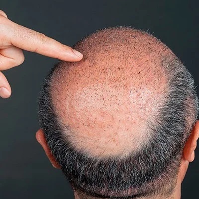 زراعة الشعر في دبي