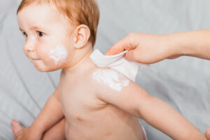 cream for baby eczema