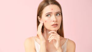 Acne Treatment in Dubai: Why Early Treatment Helps Prevent Acne Scarring