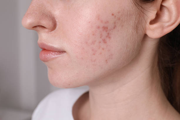 Can Acne Treatment Improve Uneven Skin Texture